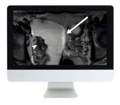 ARRS Pitfalls in GI Imaging 2022