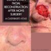 Combination Facial Reconstruction After Mohs Surgery: A Case Based Atlas (Original PDF From Publisher)