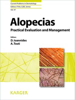 Alopecias – Practical Evaluation and Management (Current Problems in Dermatology Book 47) 1st Edition (PDF Book)