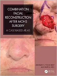 Combination Facial Reconstruction after Mohs Surgery ( pdf )