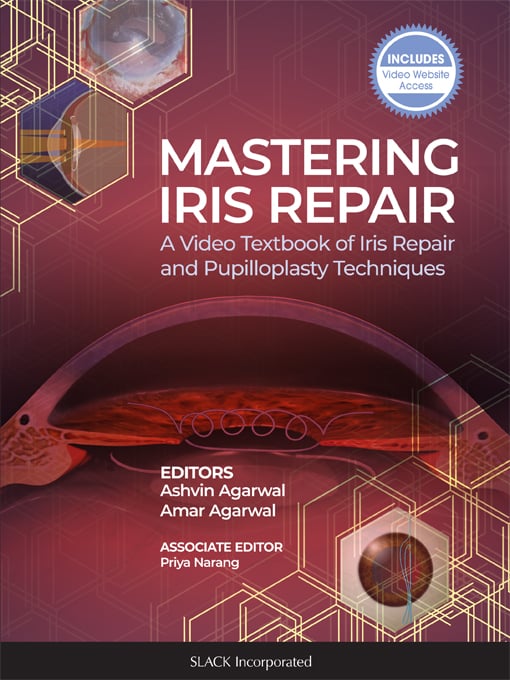 Mastering Iris Repair: A Video Textbook of Iris Repair and Pupilloplasty Techniques (PDF Book)