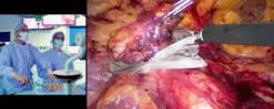 Alternative view of surgical Video Articles JOMI Video Journal Peer Reviewed 2023