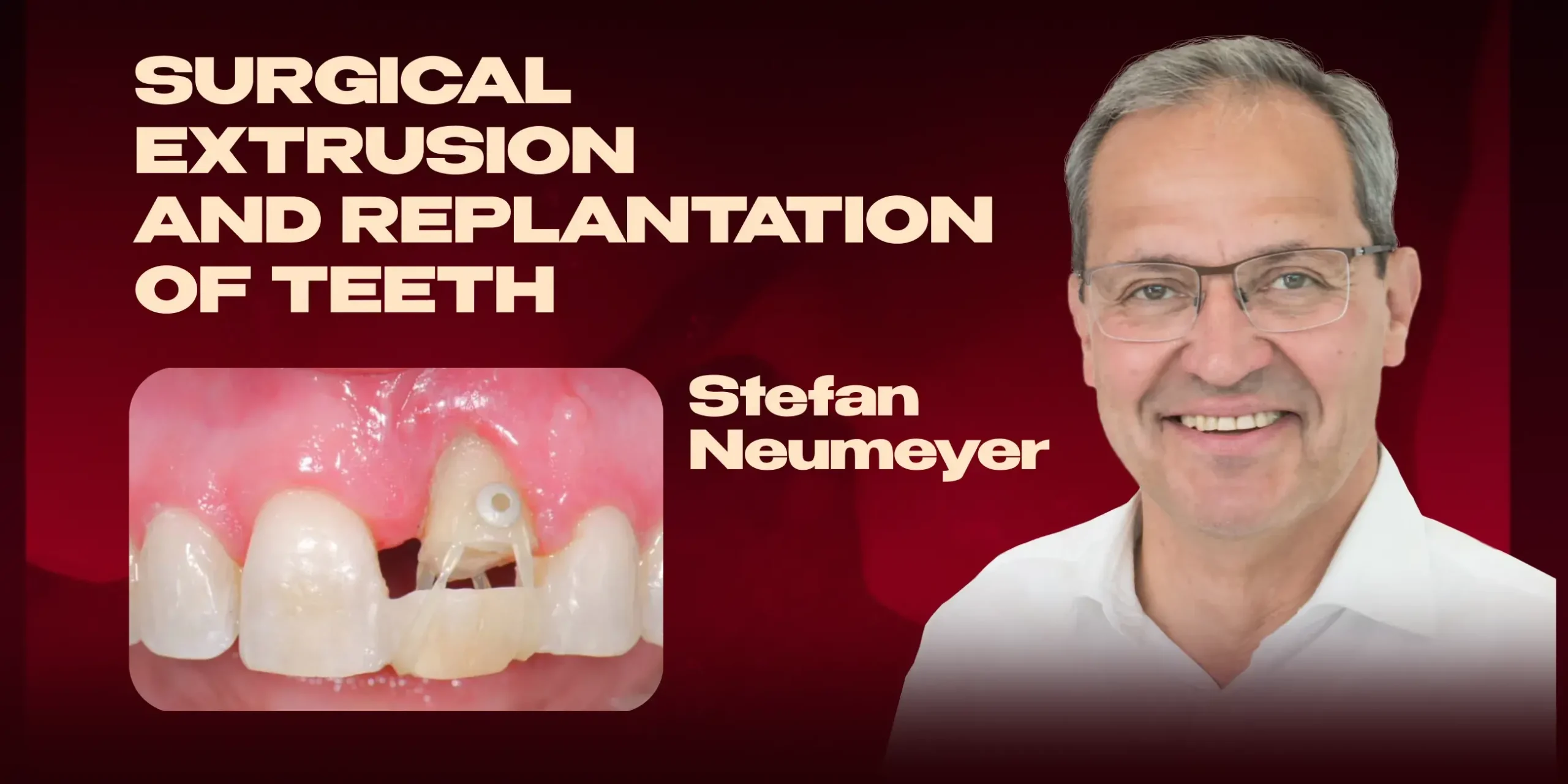 OHI-S Surgical Extrusion and Replantation of Teeth