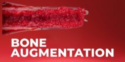 OHI-S Bone Augmentation Current Techniques
