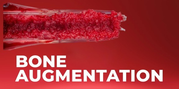 OHI-S Bone Augmentation Current Techniques