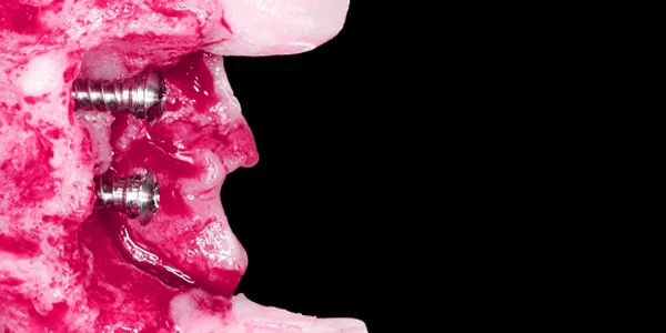 OHI-S Implantation Without Peri-Implantitis