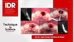 pikos-institute-immediate-dentoalveolar-restoration