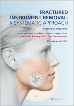 Indirect Restorations in Dentistry – A Complete GuideFractured Instrument Removal: A Systematic Approach