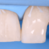 Gidedental Direct and Indirect Adhesive Restorations