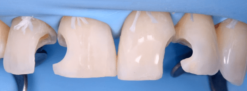 Gidedental Direct and Indirect Adhesive Restorations