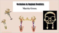 Occlusion in Implant Dentistry – Martin Gross (Course)
