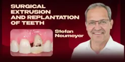 OHI-S Surgical Extrusion and Replantation of Teeth