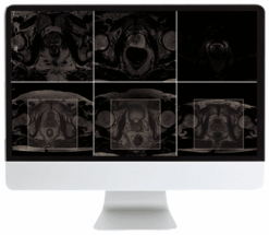 ARRS Pearls and Pitfalls in Prostate and Pelvic Imaging 2021