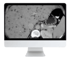 ARRS State of the Art Liver Imaging in Cirrhosis 2021