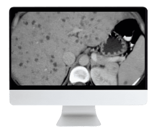ARRS State of the Art Liver Imaging in Cirrhosis 2021
